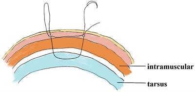 The small incisions combined with interrupted buried suture blepharoplasty: flexible-rigid fixation